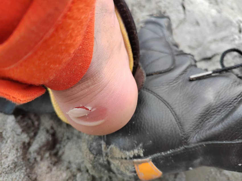 長途的救援跋涉，消防員腳后跟磨壞。四川省森林消防總隊供圖