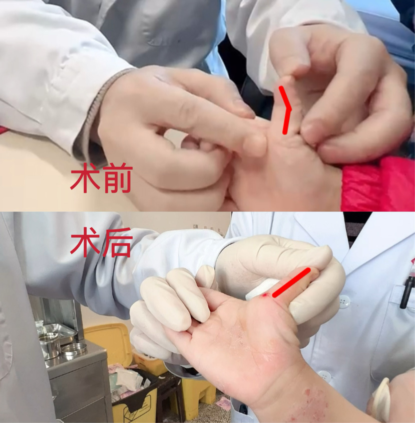 治療前后患者情況對比。四川省骨科醫院供圖